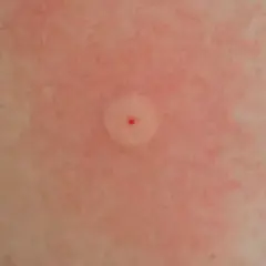 Ett rött, svullet bett med en liten röd prick i mitten, ett tydligt tecken på att bin kan stickas. Huden runt är irriterad.