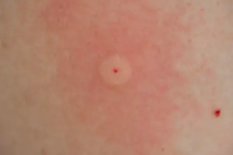 Ett rött, svullet bett med en liten röd prick i mitten, ett tydligt tecken på att bin kan stickas. Huden runt är irriterad.