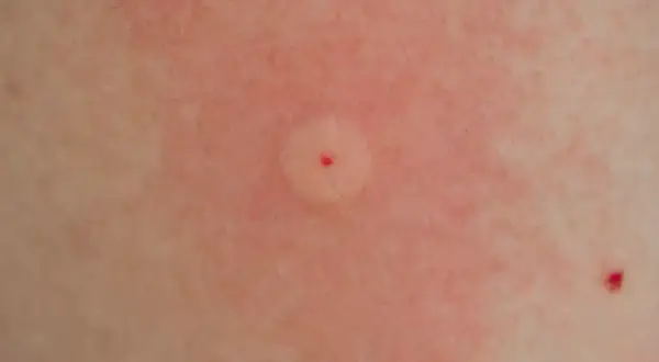 Ett rött, svullet bett med en liten röd prick i mitten, ett tydligt tecken på att bin kan stickas. Huden runt är irriterad.