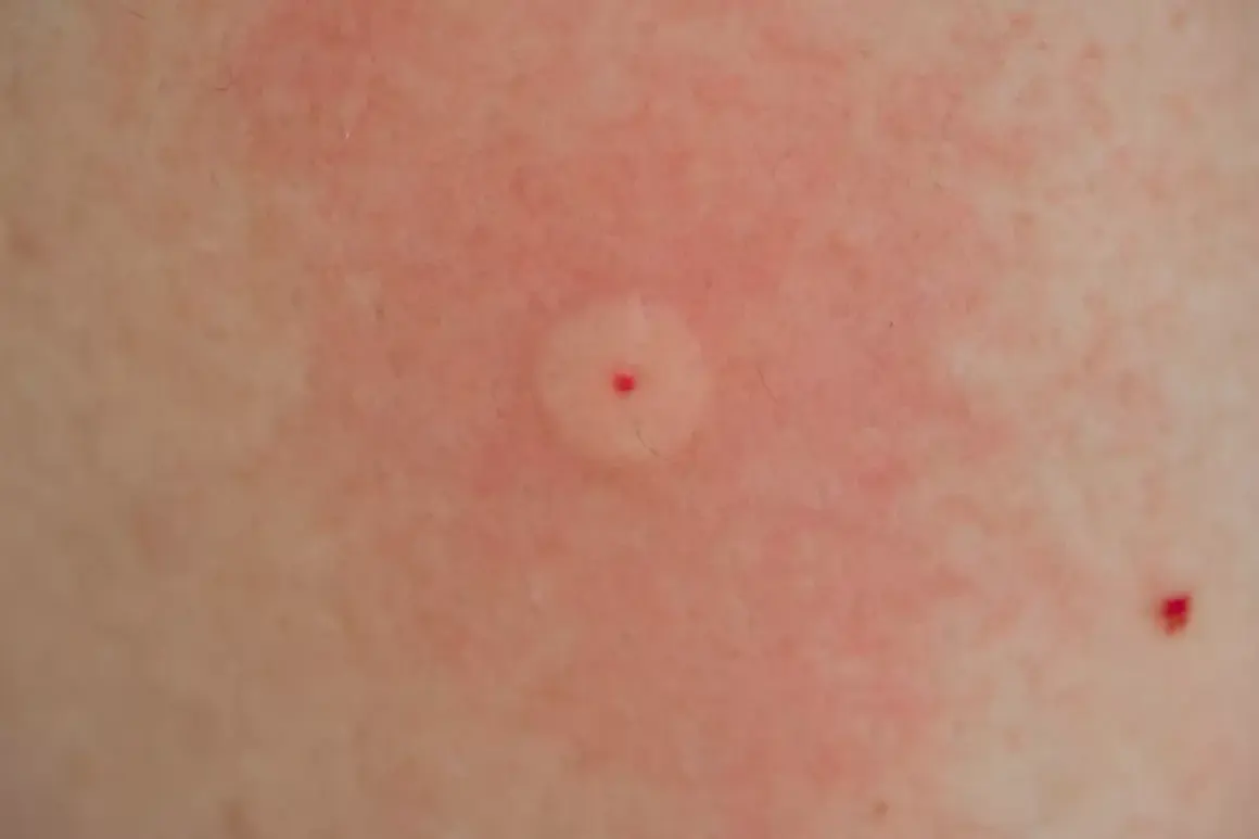 Ett rött, svullet bett med en liten röd prick i mitten, ett tydligt tecken på att bin kan stickas. Huden runt är irriterad.