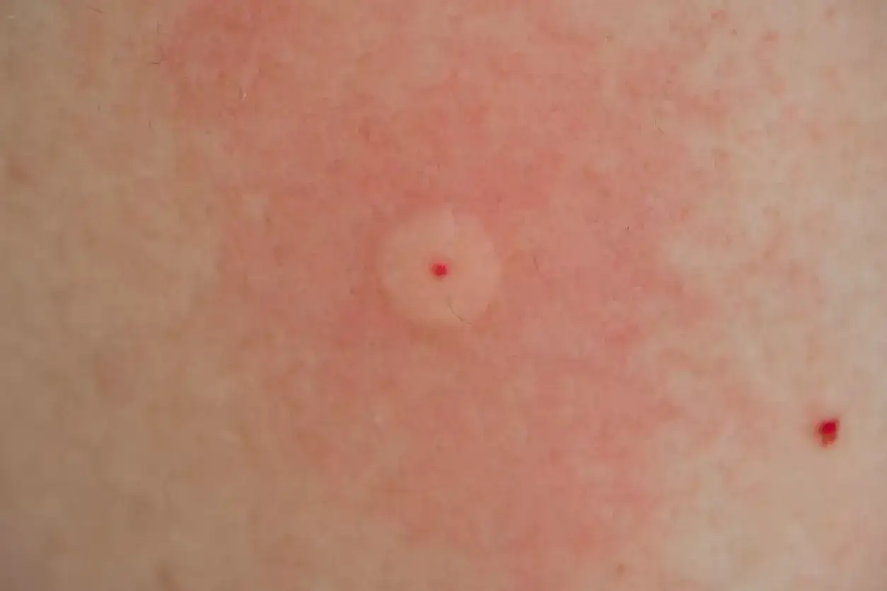 N&auml;rbild p&aring; hud med rodnad och en liten svullnad med en r&ouml;d prick i mitten, typiskt getingstick utseende.